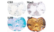 Den Ursachen von Multipler Sklerose auf der Spur